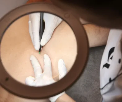 Geste epilation haute frequence, electrolyse essence yelle montpellier