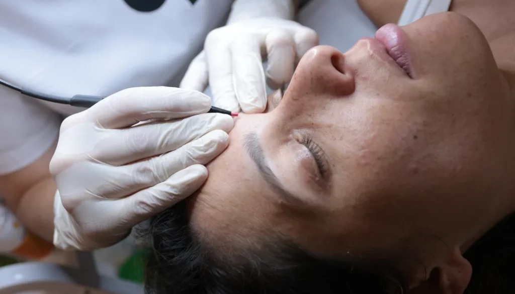 Epilation Haute frequence intersoucils femme epilation definitive electrolyse, haute frequence essence yelle montpellier