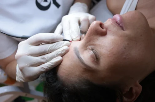 Epilation Haute frequence intersoucils femme epilation definitive electrolyse, haute frequence essence yelle montpellier Epilation Haute frequence intersoucils femme epilation definitive electrolyse, haute frequence essence yelle montpellier