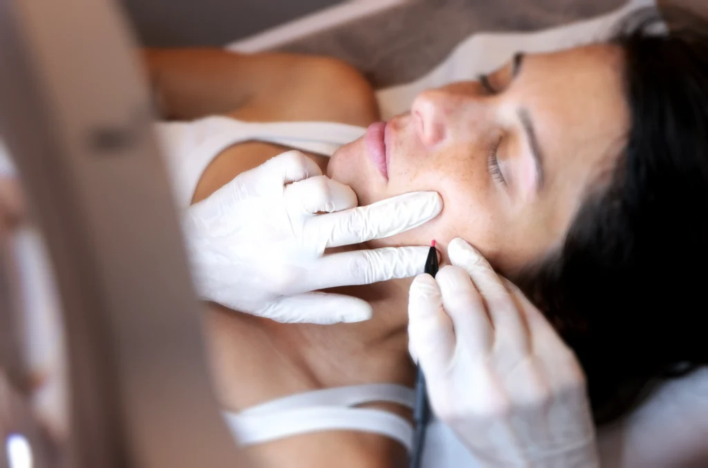 Epilation Haute frequence joue femme epilation definitive electrolyse, haute frequence essence yelle montpellier