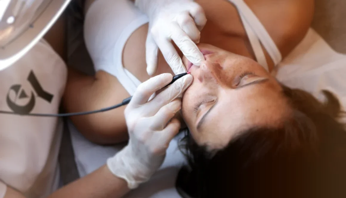 Epilation Haute frequence moustache arriere femme epilation definitive electrolyse, haute frequence essence yelle montpellier