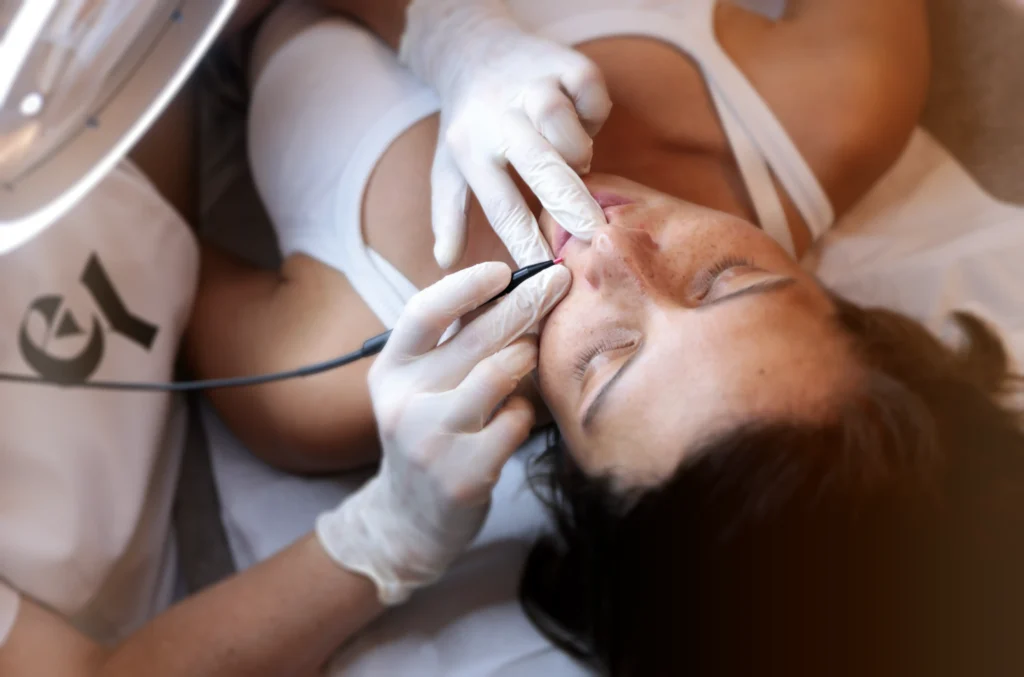 Epilation Haute frequence moustache arriere femme epilation definitive electrolyse, haute frequence essence yelle montpellier