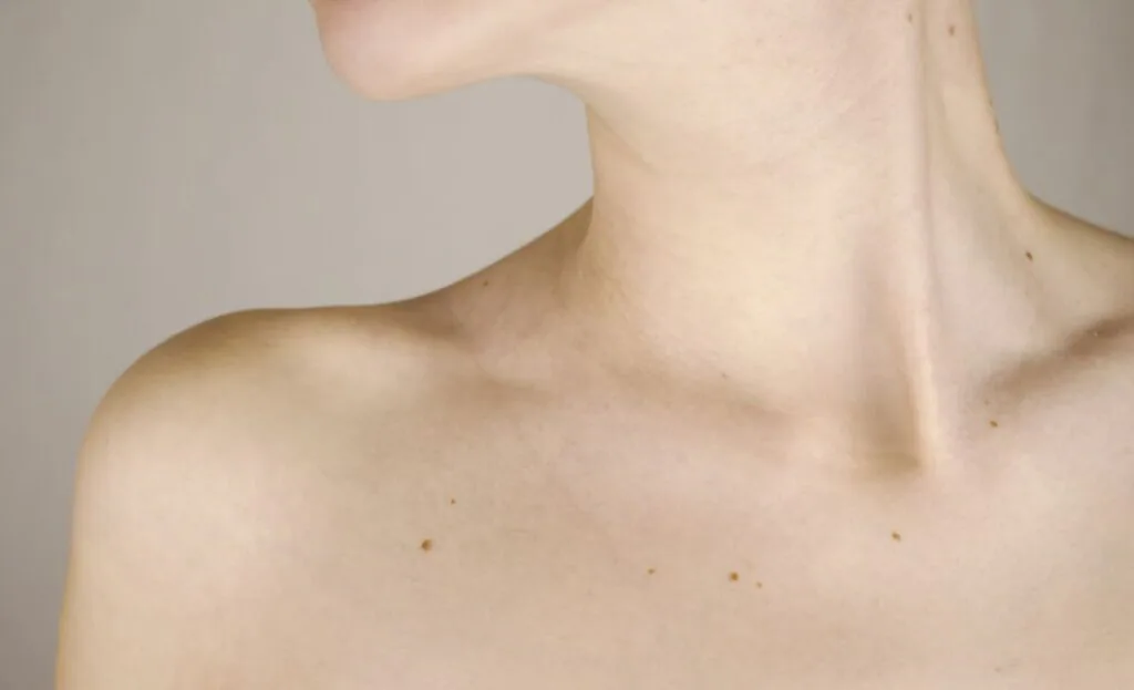épilation définitive grain de beauté