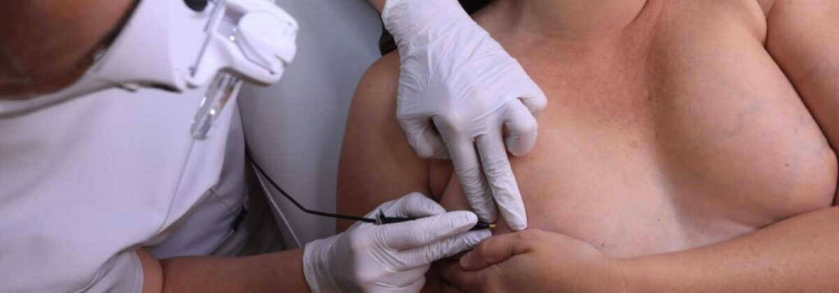 Épilation autour des aréoles chez la femme – un soin d’électrolyse délicat et précis réalisé dans notre institut Essence Yelle à Montpellier